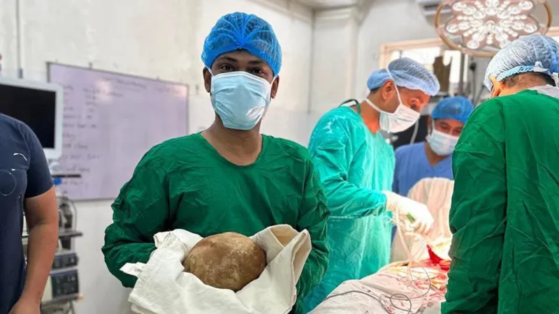 श्रीलंकामा बिरामीको मूत्रथैलीबाट ३ किलो भन्दा बढिको ढुंगा निकालियो